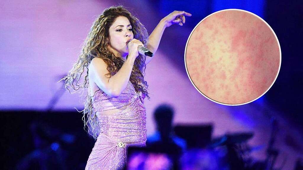 Alarma brote de sarampión tras concierto de Shakira en EE.UU.