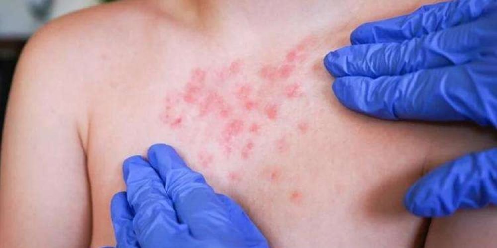 alerta-epidemiologica-sarampion-america-latina