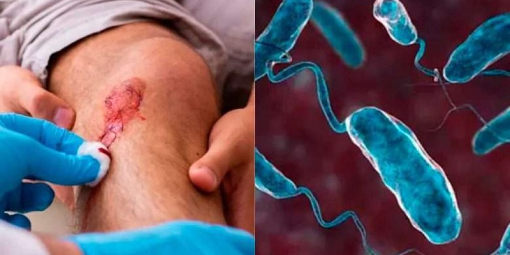 alerta-japon-bacteria-carnivora-mata-en-dos-dias