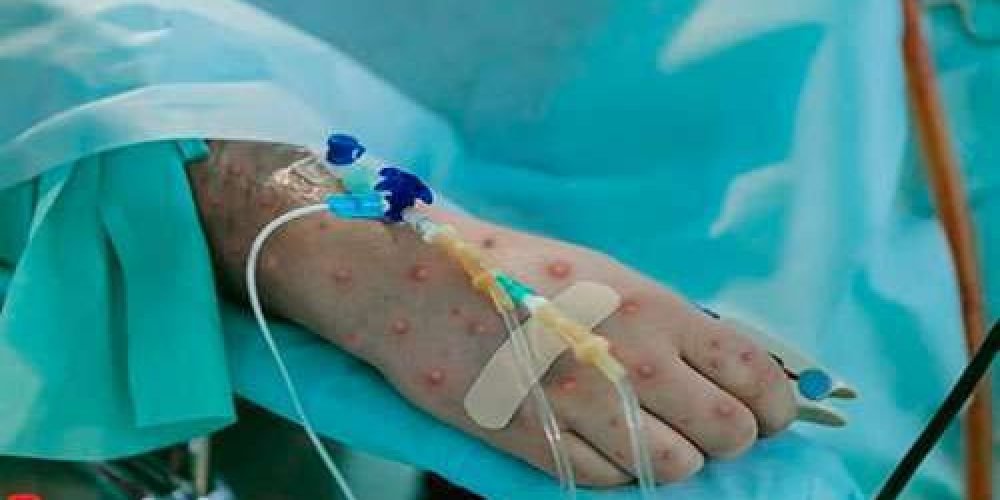 alerta-primer-caso-mortal-viruela-de-alaska