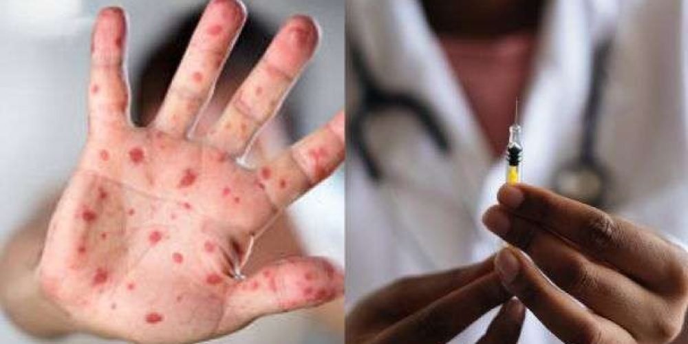 contagio-prevencion-viruela-del-mono