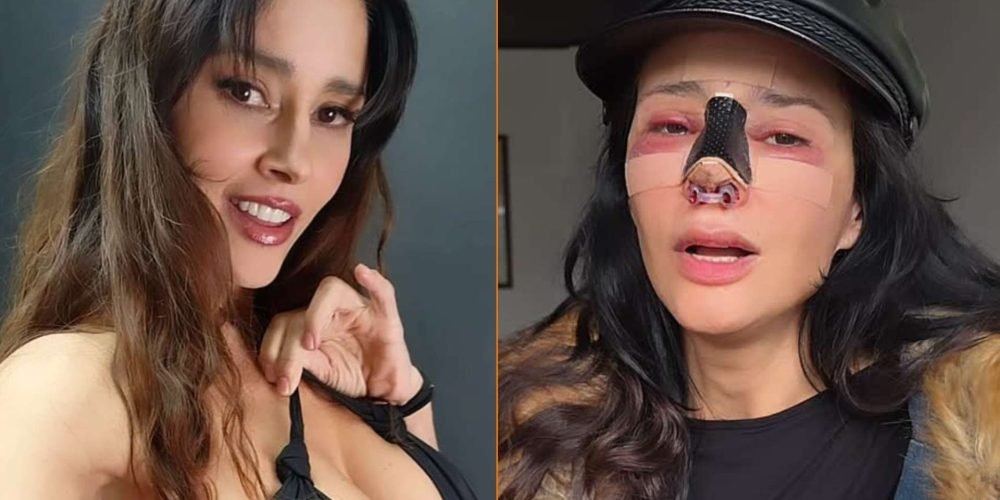 dorismar-reaparece-reconstruccion-cirugia-mal-hecha-nariz