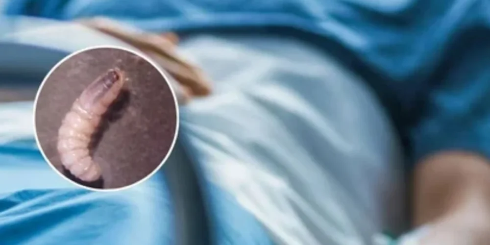 estados-unidos-primer-caso-humano-gusano-barrenador-agosto-2025