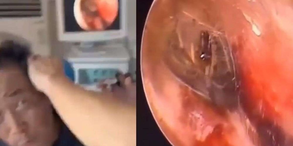 hombre-nido-arana-oido