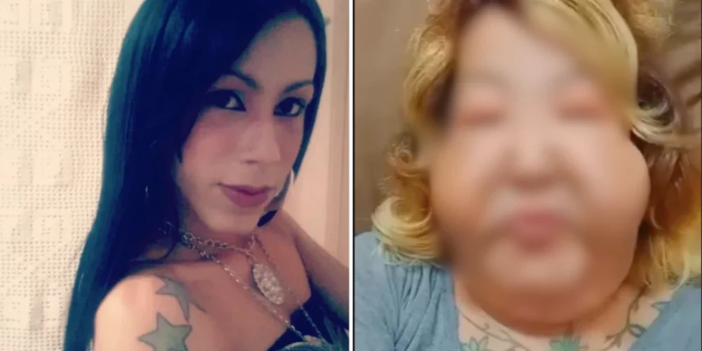 influencer-Juliana-Oliveira-desfigurada-inyecciones-esteticas-clinica-ilegal