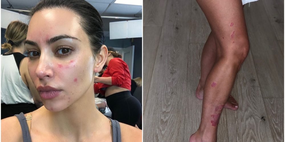 kim-kardashian-psoriasis