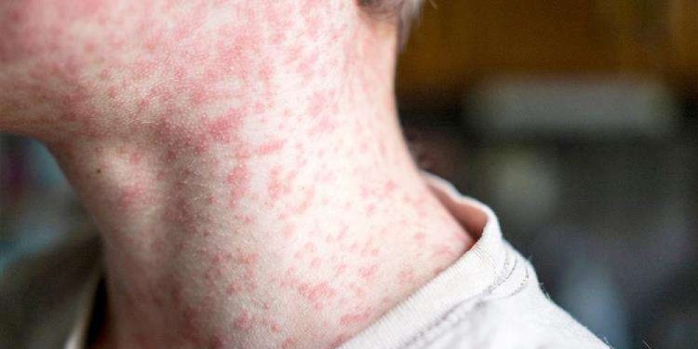 mexico-lider-muertes-sarampion-america-octubre-2025