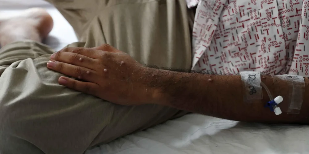 mpox-virula-del-mono-simica-sin-entrar-en-panico