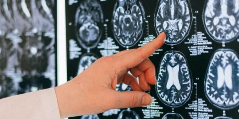 nino-cura-cancer-cerebral-primer-caso-exitoso-mundo