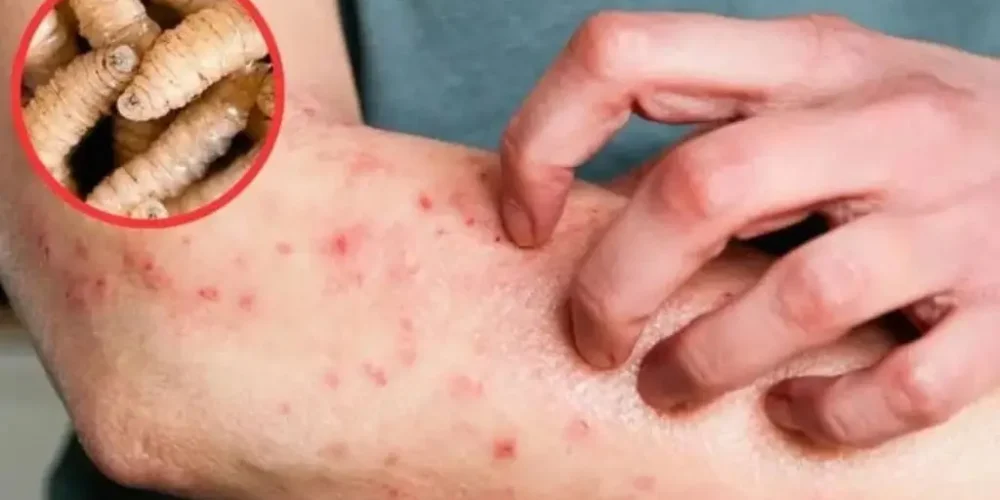 octavo-caso-humano-gusano-barrenador-yucatan