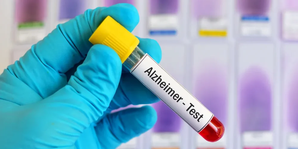 prueba-sangre-detecta-94-por-ciento-precision-alzheimer