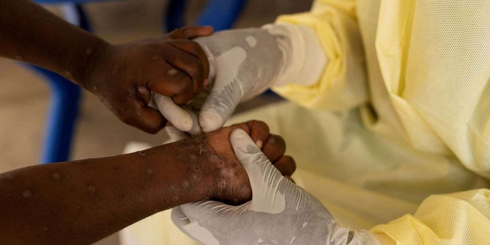 sintomas-viruela-del-mono-mpox